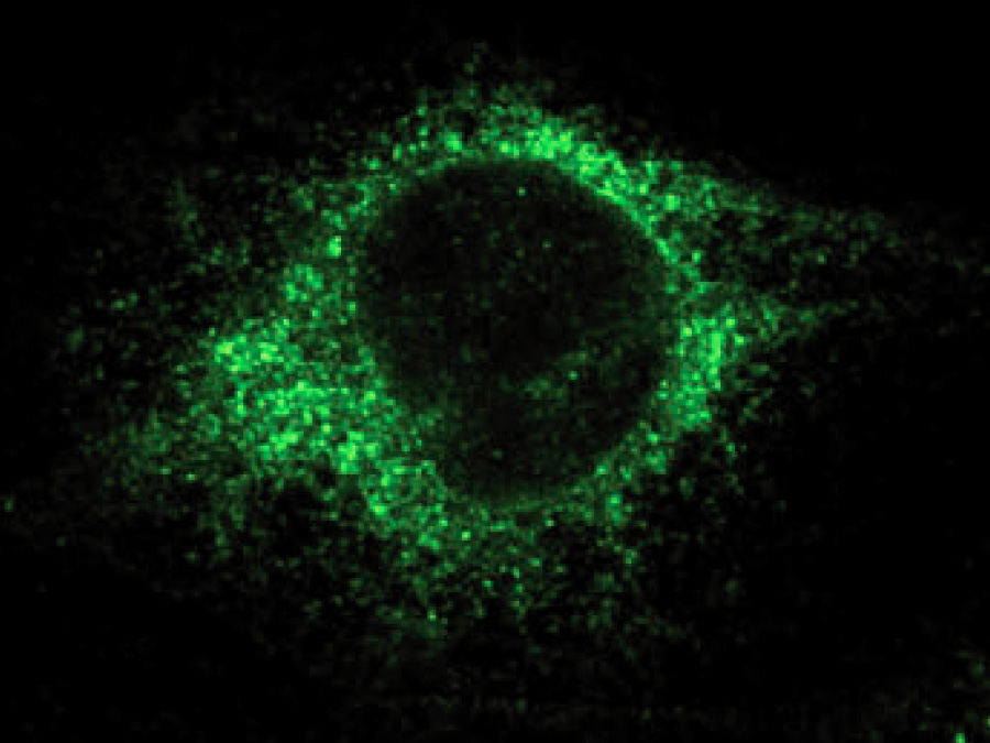 Specific staining of the enzyme PDI in breast cancer cells. - Photo: LMU