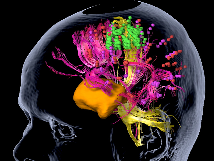 nTMS mapping of a tumor (orange): Neural pathways and essential position points for language regions are shown in pink, important points for motor areas in green, and neural pathways for motor areas in yellow. (Graphic: Sandro Krieg / TUM)