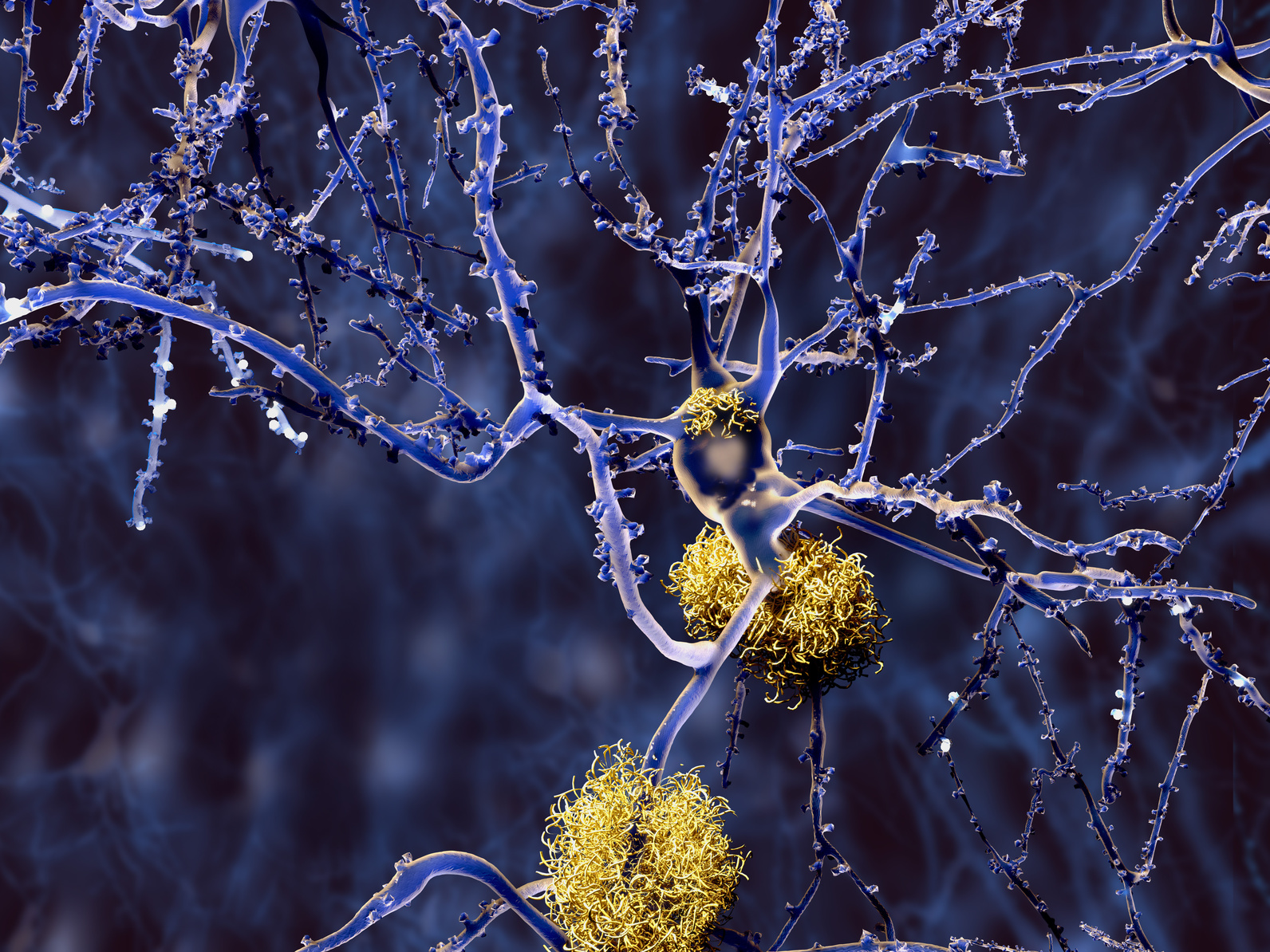Ein Neuron mit Amyloid-Plaques. (Foto: Juan Gärtner/ Fotolia)
