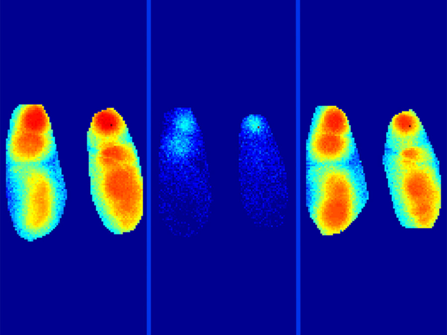 Darstellung von langsamen Wellen im Gehirn, die sich während des Schlafes normal ausbreiten (links). Durch die Amyloid-β-Plaques wird dieser Prozess massiv gestört (Mitte). Diese Störung wird durch die Gabe eines Benzodiazepins behoben (rechts). (Bild: Marc Aurel Busche / TUM)