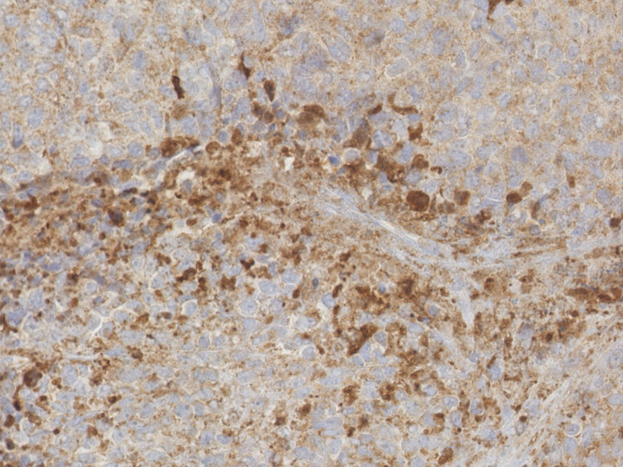 Ewing sarcoma in a mouse after application of inhibitor JQ1 (section): the tumor cells exhibiting the early stages of cell death are stained brown. Ewing sarcoma in a mouse after application of inhibitor JQ1 (section): the tumor cells exhibiting the early stages of cell death are stained brown.