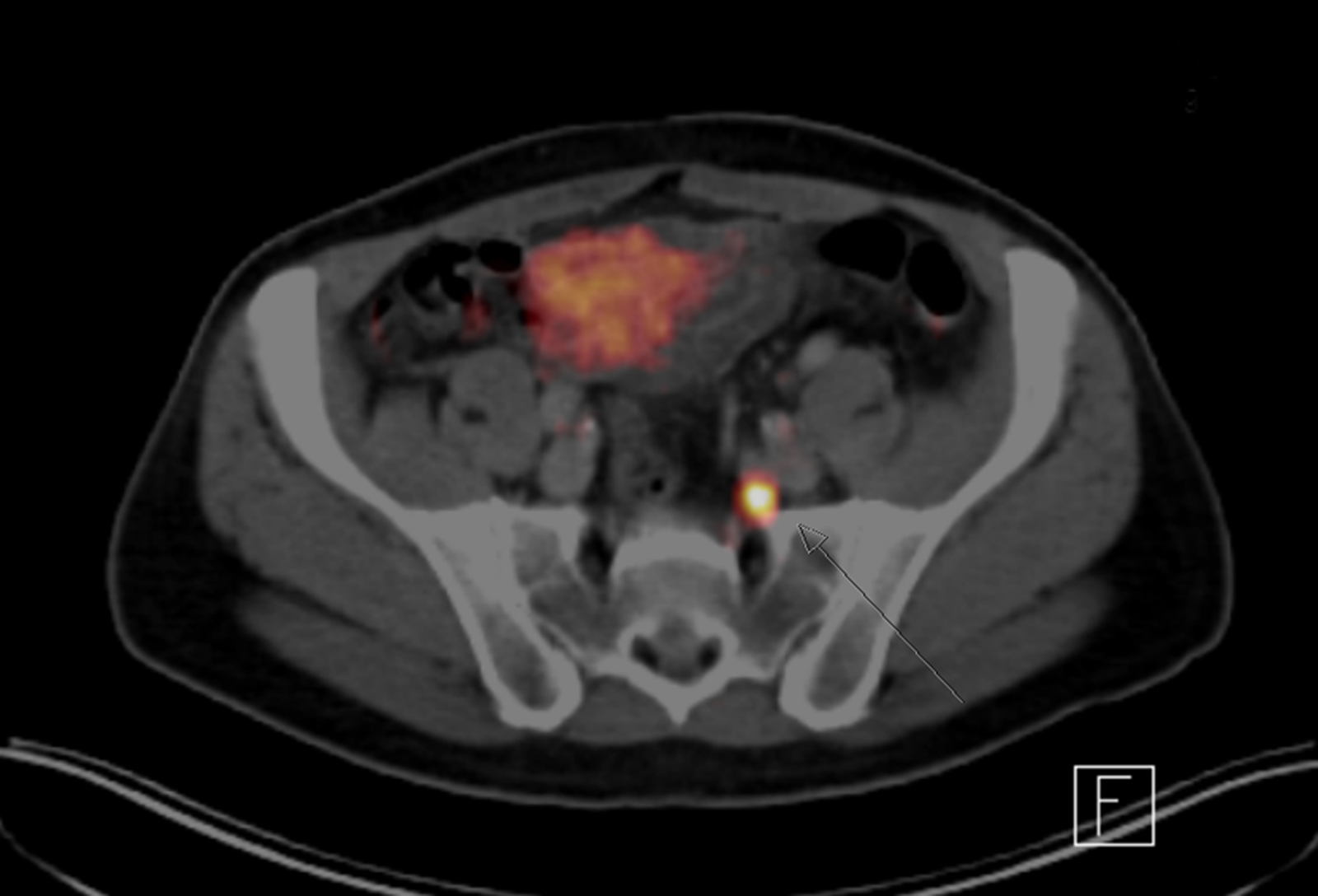 PET/CT-Aufnahme eines Beckens. Hell hervorgehoben ist ein Lymphknoten mit Metastasen. (Foto: Nuklearmedizin / TUM)