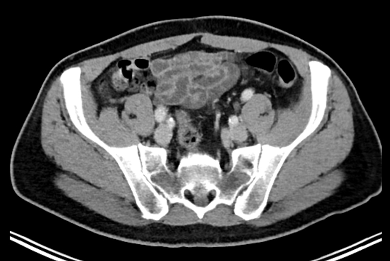 CT-Aufnahme eines Beckens ohne auffällige Lymphknoten. (Foto: Nuklearmedizin / TUM)