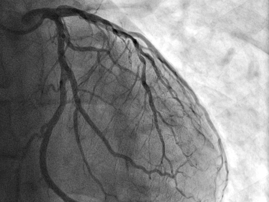 An image of the blood vessels on a heart muscle.