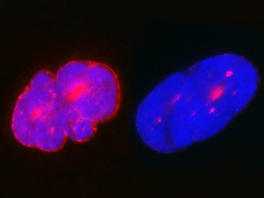 Das Bild zeigt zwei Zellkerne mit menschlicher DNA (blau). Aufgrund der großen Menge an Progerin (rot) verformen sich die Kerne in Zellen von HGPS-Patienten (links) im Vergleich zu normalen Kernen (rechts), die nur sehr wenig Progerin enthalten. (Bild: K Das Bild zeigt zwei Zellkerne mit menschlicher DNA (blau). Aufgrund der großen Menge an Progerin (rot) verformen sich die Kerne in Zellen von HGPS-Patienten (links) im Vergleich zu normalen Kernen (rechts), die nur sehr wenig Progerin enthalten. (Bild: K. Djabali / TUM)