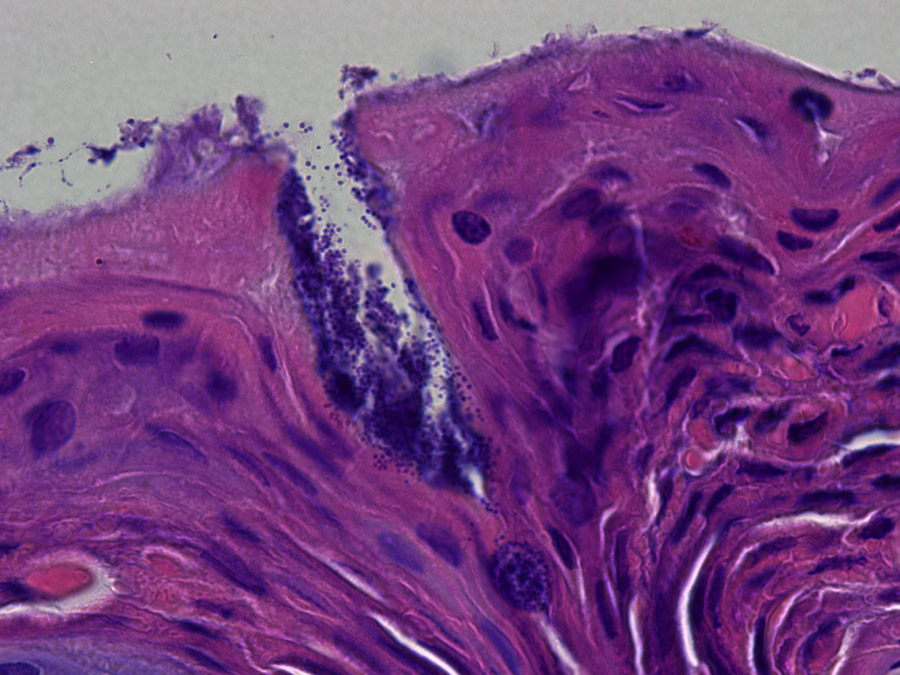 The picture shows the skin of a patient with neurodermatitis (histological staining), which is covered with Staphylococcus aureus bacteria (dark dots on the surface and in the nick). (Picture: Y. Skabytska / Universität Tübingen)