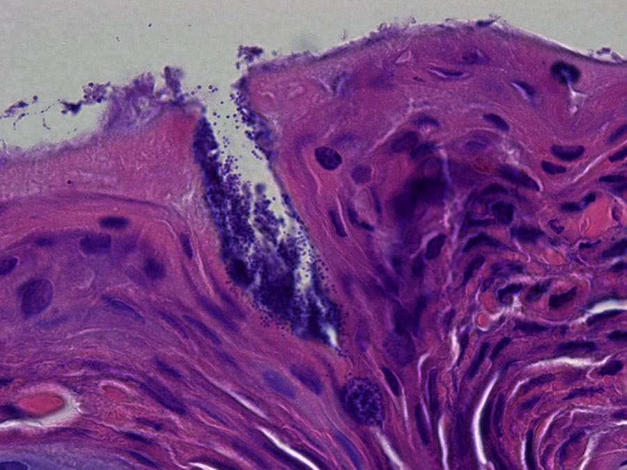 Auf der Abbildung ist die Haut eines Patienten mit Neurodermitis zu sehen (histologische Färbung), die mit Staphylococcus aureus Bakterien (dunkle Punkte auf der Oberfläche und in der Kerbe) bedeckt ist. (Bild: Y. Skabytska / Universität Tübingen)