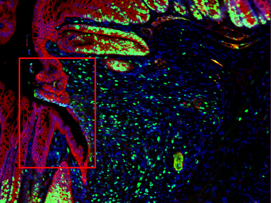 Cross section of an injury in the large intestine.