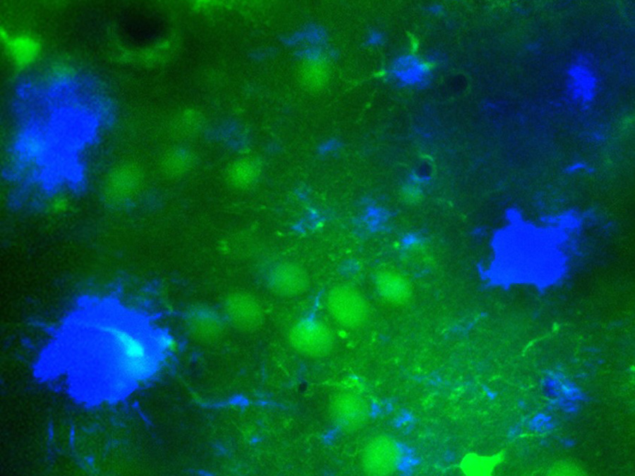 Mikroskopischer Einblick ins Alzheimer-Gehirn mit grün fluoreszierenden Nervenzellen in der Nähe der typischen Amyloid-Plaques (in blau dargestellt). (Bild: M. A. Busche / TUM)