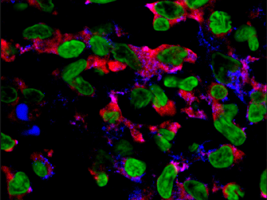 The picture shows cells in human psoriatic skin lesions of psoriasis patients before IL-4 therapy. The signaling molecule IL-23 was stained with a red dye, the cell nuclei with a green one. (Picture: E. Guenova, Y. Skabytska, W. Hoetzenecker, G. Weindl, K. Sauer, M. Tham, K.-W. Kim, J.-H. Park, J. H. Seo, D. Ignatova, A. Cozzio, M. P. Levesque, T. Volz, M. Köberle, S. Kaesler, P. Thomas, R. Mailhammer, K. Ghoreschi, K. Schäkel, B. Amarov, M. Eichner, M. Schaller, R. A. Clark, M. Röcken, und T. Biedermann, IL-4 abrogates TH17 cell-mediated inflammation by selective silencing of IL-23 in antigen-presenting cells, PNAS, Feb 2015, 112(7), 2163–2168, doi: 10.1073/pnas.1416922112.)