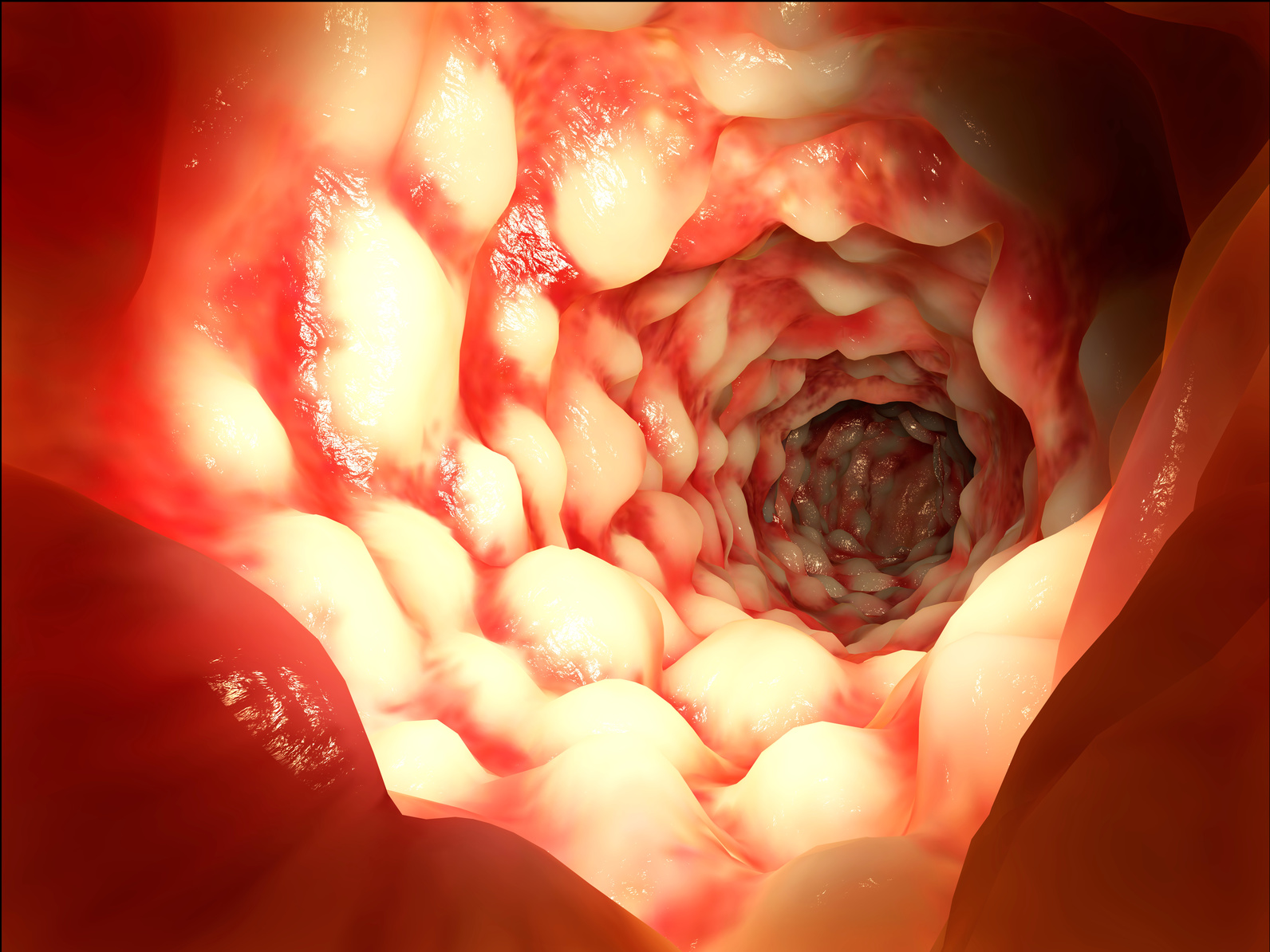Ein Darm eines Patienten von innen, der an Morbus Crohn erkrankt ist. (Foto: Fotolia/ Juan Gärtner)