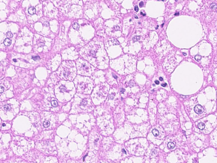 Die Abbildung zeigt einen histologischen Gewebeschnitt einer Steatoheaptitis im Menschen. (Bild: A. Weber / Universitätsspital Zürich, Erklärung s. unten)