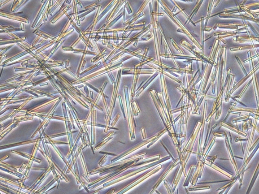 Aufnahmen von Harnsäurekristallen: Harnsäure bildet nadelförmige Kristalle, die das Immunsystem aktivieren. (Bild: K. Neumann/TUM)