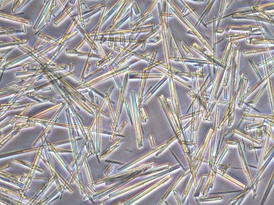 Picture of uric acid crystals: Uric acid forms needle-like crystals which activate the immune system.