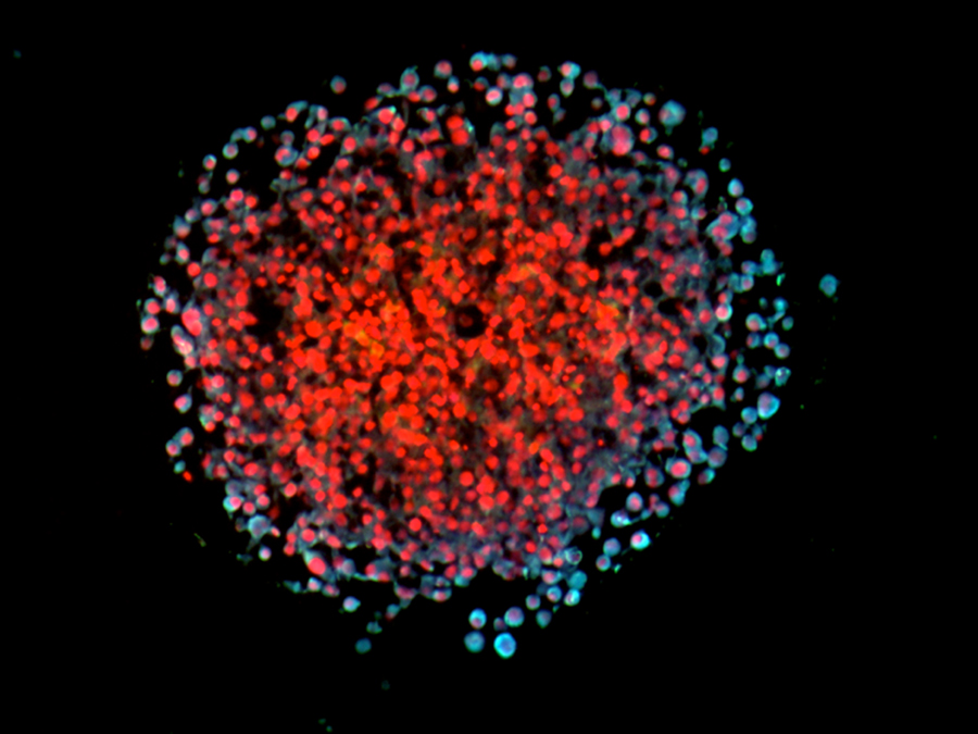 3D spheroid of cultivated breast cancer cells. Invasive cells show a light blue co-staining for the leptin receptor and a marker of epithelial-mesenchymal transition (i.e. the ability of cells to metastasize). Cell nuclei are stained in red. (Image: Helmholtz Zentrum München)