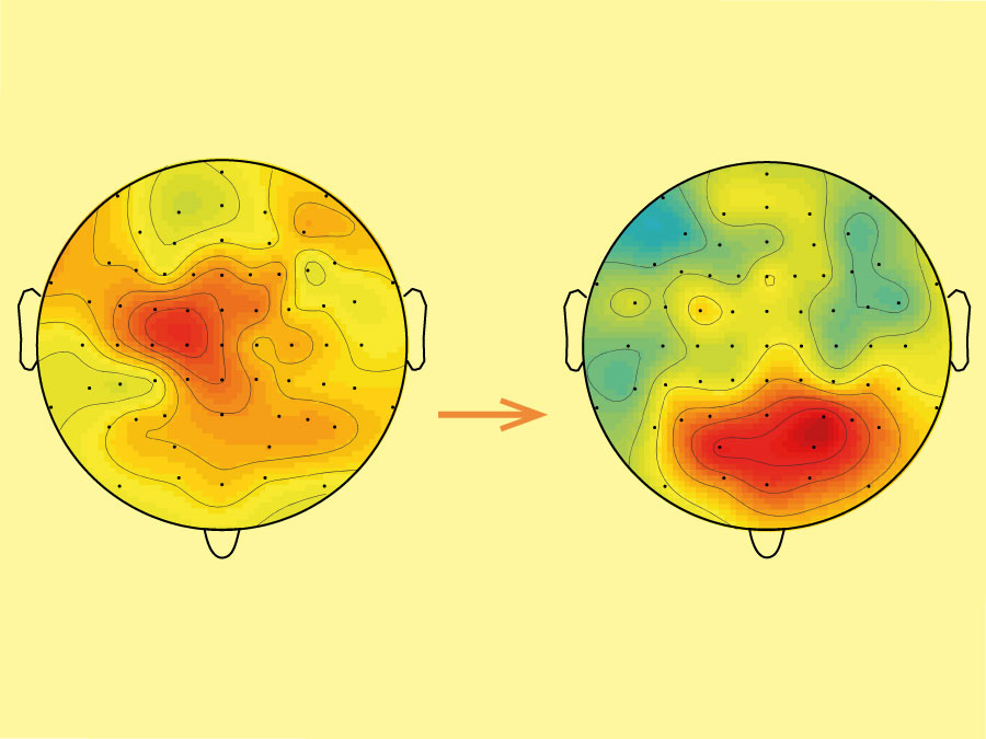 Das Bild zeigt die EEG-Ergebnisse während eines kurzen (links) und eines langandauernden Schmerzreizes (rechts). Die Hirnbereiche mit der stärksten Aktivität erscheinen rot. Kurzer Schmerz wird in sensorischen Bereichen verarbeitet, langandauernder Schmerz eher in emotionalen Hirnbereichen in der Stirnregion. (Bild: E. Schulz et al., 2015, Prefrontal gamma oscillations encode tonic pain in humans, Cerebral Cortex, doi10.1093/cercor/bhv043, modifiziert)