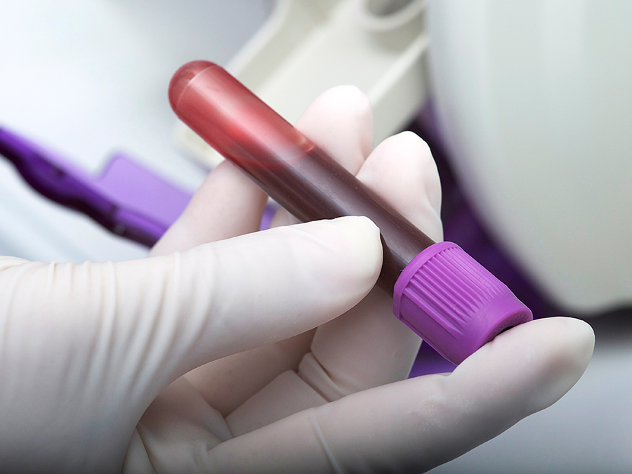 Für den neuen Bluttest werden Blutproben der Patienten entnommen und auf zwei Proteinmarker untersucht. (Bild: Gab13 / istockphotos) Für den neuen Bluttest werden Blutproben der Patienten entnommen und auf zwei Proteinmarker untersucht. (Bild: Gab13 / istockphotos)
