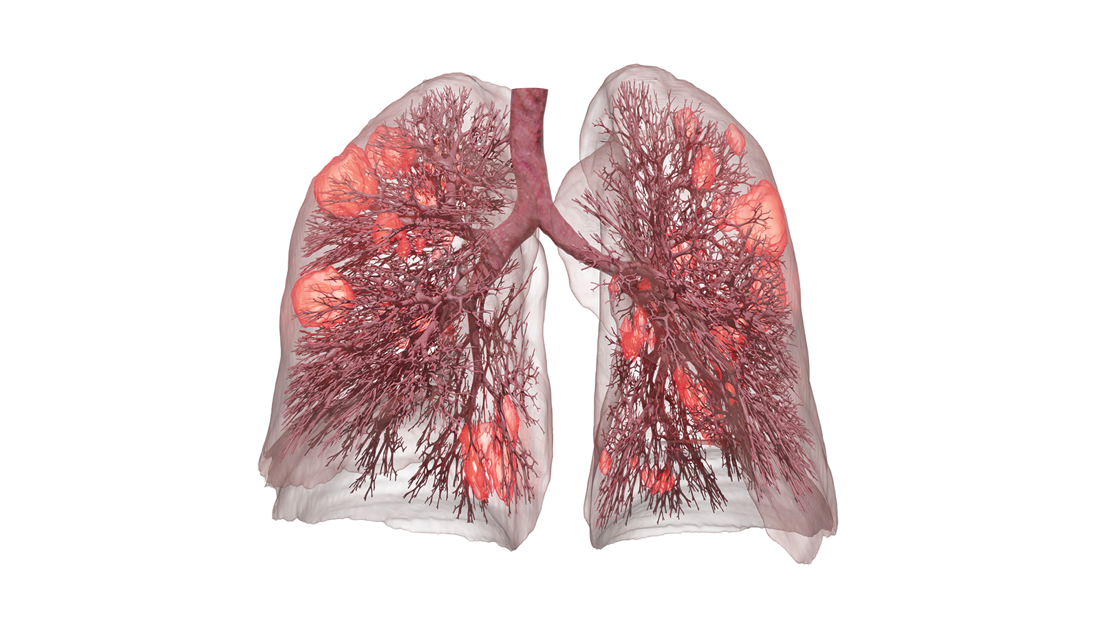 Utilizing data compiled from a CT lung scan, the software uses artificial intelligence to calculate the condition and health of a patient’s lungs. In this image, damage caused by a COVID-19 infection is marked in orange.